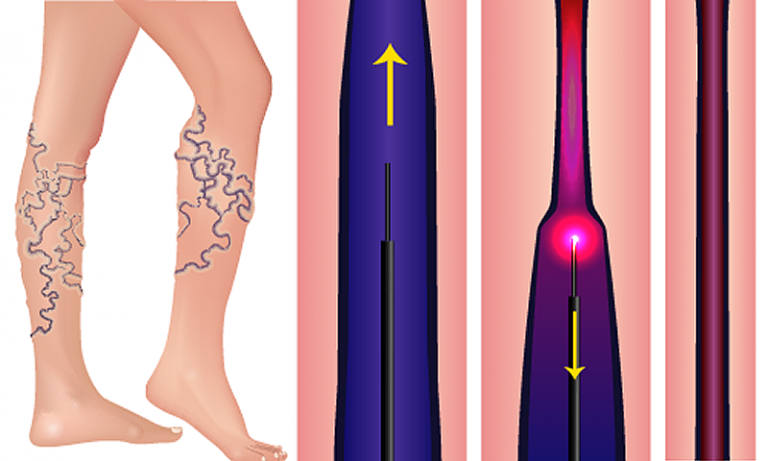 Laser Treatment For Spider Leg Vein Removal - Sydney Vein Clinics