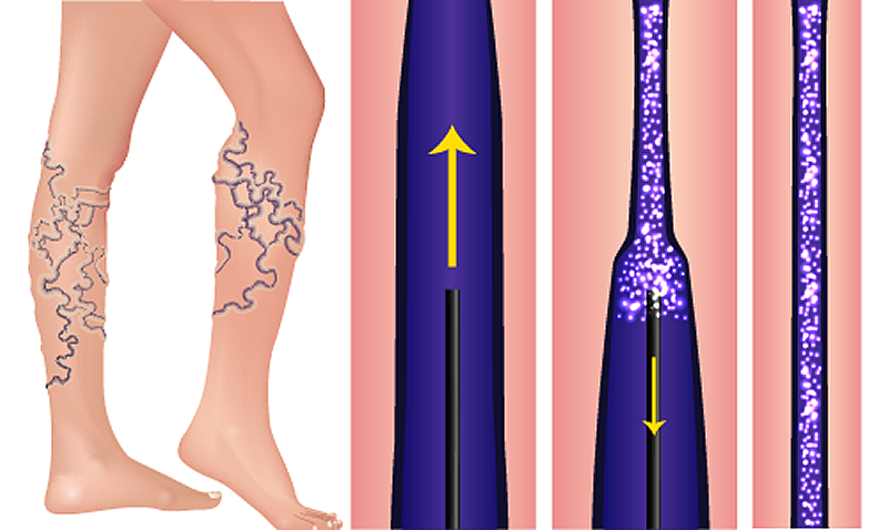 How Soon Will Veins Disappear After Sclerotherapy?